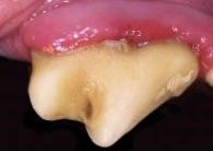periodontal disease stage 3