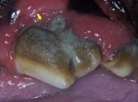 periodontal disease stage 4